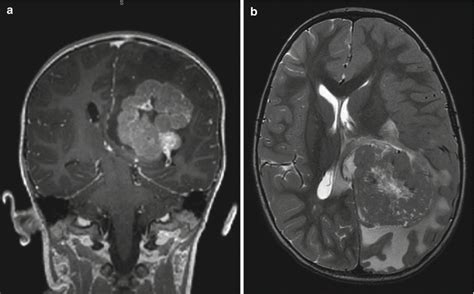 Choroid Plexus Tumors | Oncohema Key