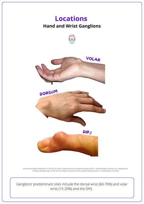 Ganglion Cyst Wrist Anatomy – NBKomputer