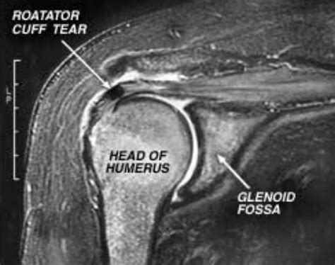 Shoulder rotator cuff tear MRI Unidad Especializada en Ortopedia y Traumatologia en Bogota ...