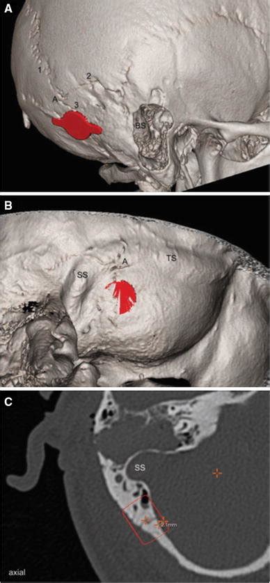 Positioning of the template at the retrosigmoidal localization. a The ...