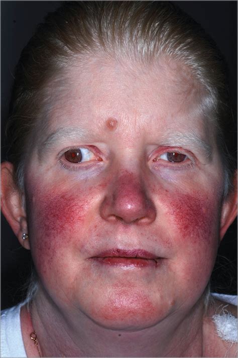 Mucocutaneous Granulomatous Disease in a Patient With Hermansky-Pudlak Syndrome | Dermatology ...