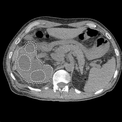 Pyelonephritis CT scan - wikidoc