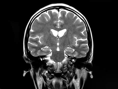 MRI shows brain microstructural changes after mild COVID-19