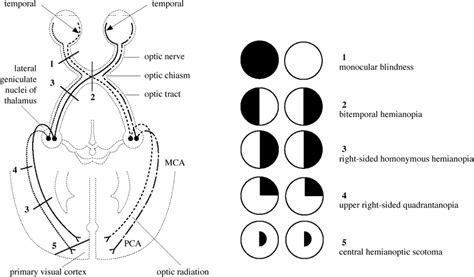 hemianopsia | Medical school stuff, School info, Visual cortex