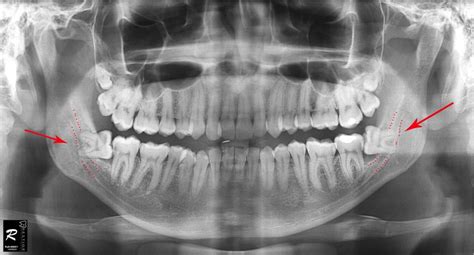 Wisdom Teeth Surgery: Cases That Was Done in Our Clinic – prestige ...