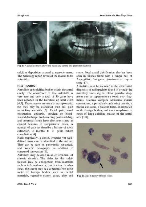 Antrolith a case report