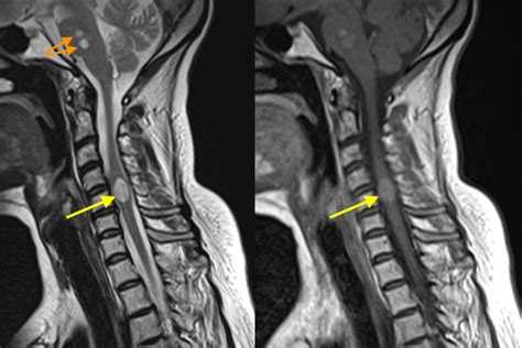 Spinal cord metastasis - MRI - Radiology at St. Vincent's University ...