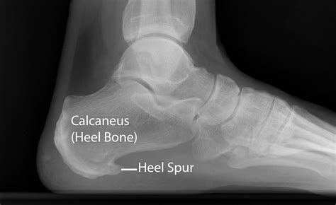 Heel Spur X Ray