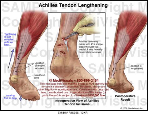 Achilles Tendon Lengthening Medical Illustration Medivisuals