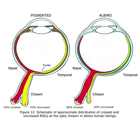 Oculocutaneous Albinism Eyes