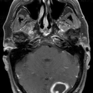 Coronal MRI image showing ring-enhancing lesion | Download Scientific Diagram