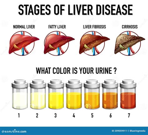 Stages Of Liver Damage. The First Symptoms Of Liver Problems Are Abdominal Pain, Swollen Belly ...