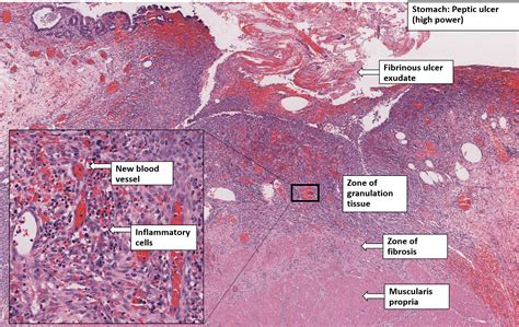 Stomach – Chronic Peptic Ulcer – NUS Pathweb :: NUS Pathweb