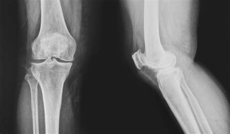 Bone loss accelerates due to vitamin C deficiency | NaturalHealth365