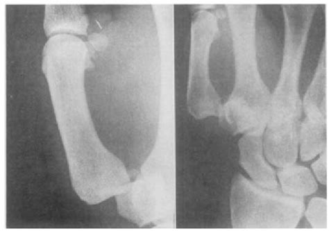 Figure 1 from Bennett’s Fracture | Semantic Scholar