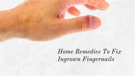 How To Treat Ingrown Fingernails At Home? Effective Methods