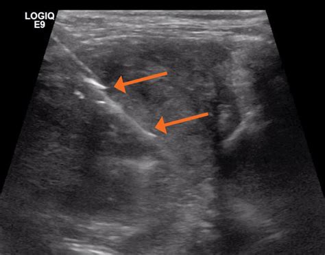 Ultrasound-Guided Fine Needle Aspiration and Core Biopsy | Today's ...