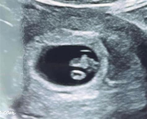 7 Week Ultrasound Heartbeat