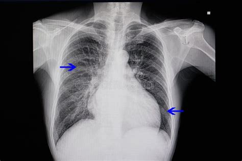 Chest X-ray of a Patient with Heart Failure Stock Photo - Image of ...