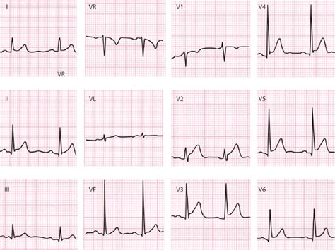 4: ECG Interpretation | Thoracic Key