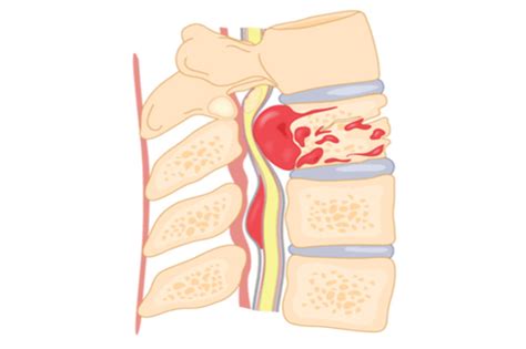 Spinal Cord Tumors: Facts, causes, symptoms,& detection | FactDr