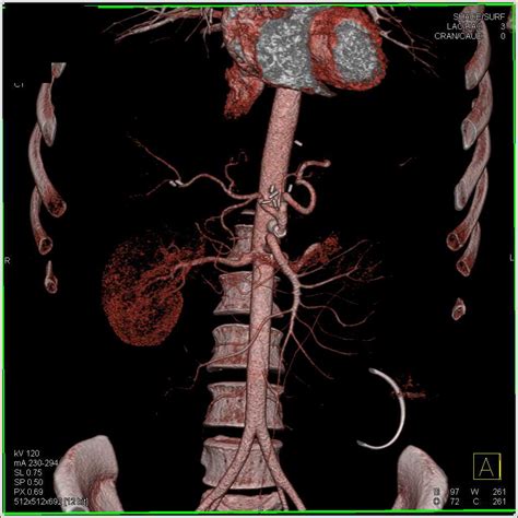 Celiac Stent in Patient with Median Arcuate Ligament Syndrome - Vascular Case Studies - CTisus ...