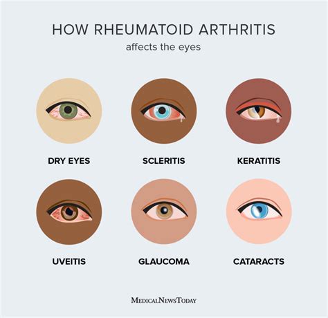 Rheumatoid arthritis and the eyes: Impact and symptoms