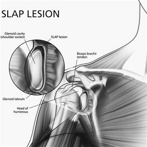 What is SLAP Lesion? - PT Master Guide