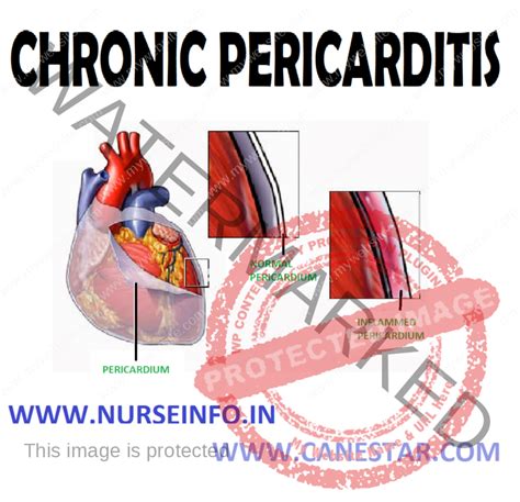 CHRONIC PERICARDITIS - Nurse Info