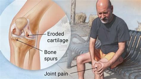 Comprehensive List of Osteoarthritis Medications » eDrugSearch.com