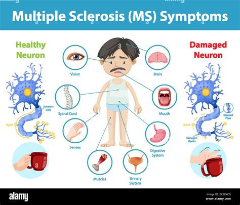 Multiple sclerosis (MS) symptoms information infographic illustration Stock Vector Image & Art ...