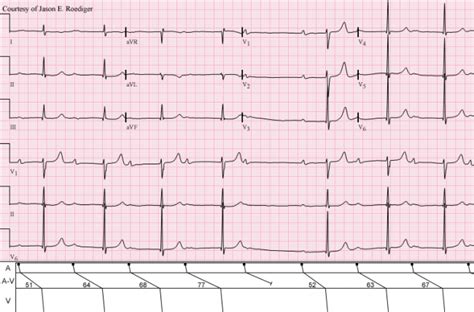 Wenckebach phenomenon | ECG Guru - Instructor Resources