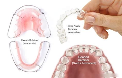 Retainer Designs And Colors Like Brace