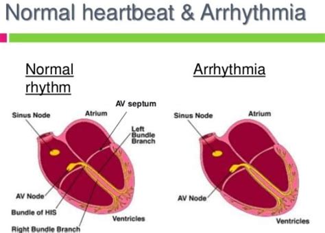 Arrhythmia Home Remedy Treatment - Home Remedy and Natural Cures