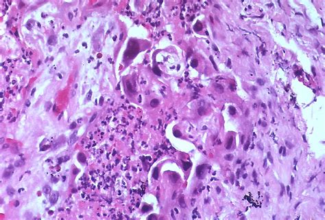 Difference Between Type 1 and Type 2 Pneumocytes | Compare the ...