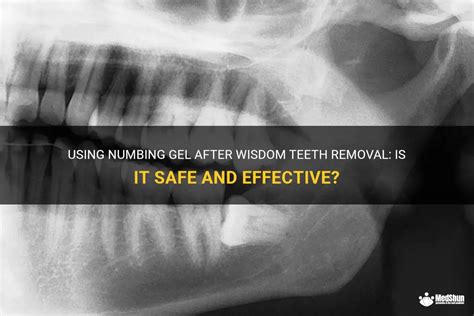 Using Numbing Gel After Wisdom Teeth Removal: Is It Safe And Effective? | MedShun