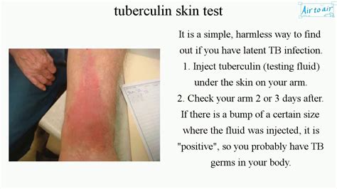 tuberculin skin test (English) - Medical terminology for medical students - - YouTube