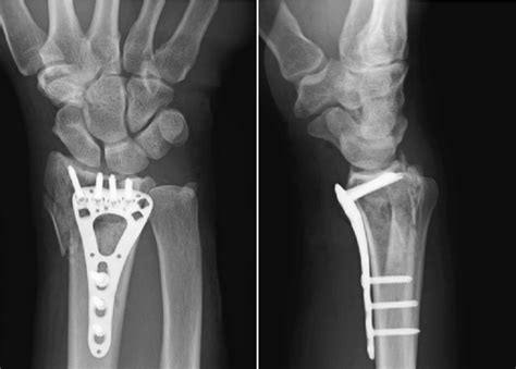 Volar Plate Fracture Radiology