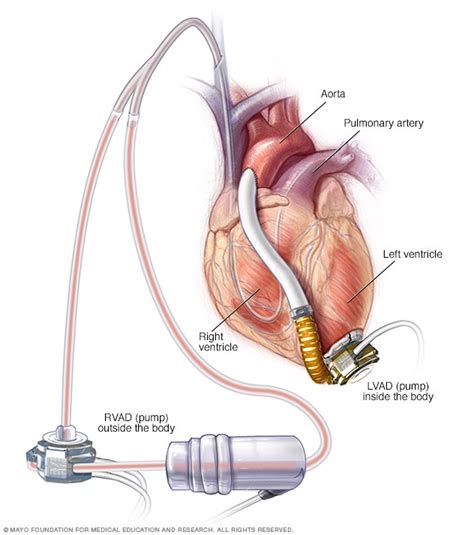 Right and left ventricular assist device - Mayo Clinic