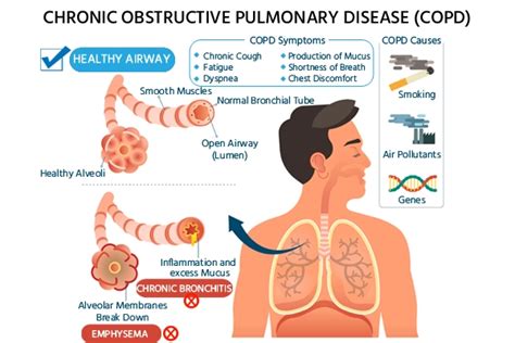 COPD: Symptoms, Causes, Risk, Diagnosis and Treatment