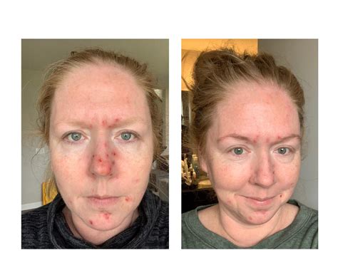 [PRODUCT REQUEST]Always had this redness to my face, it flares up and goes away-looking for a ...