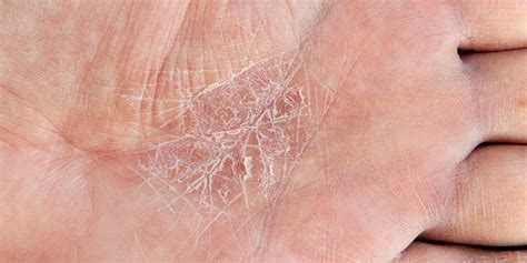 6 Eczema Symptoms You Should Bring Up With Your Derm | SELF