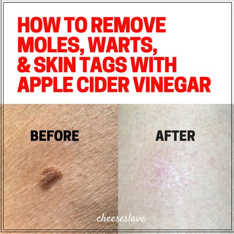 How To Remove Moles Using Apple Cider Vinegar - HOWTORMEOV