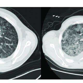 Chest HRCT of case 1 and case 2. | Download Scientific Diagram