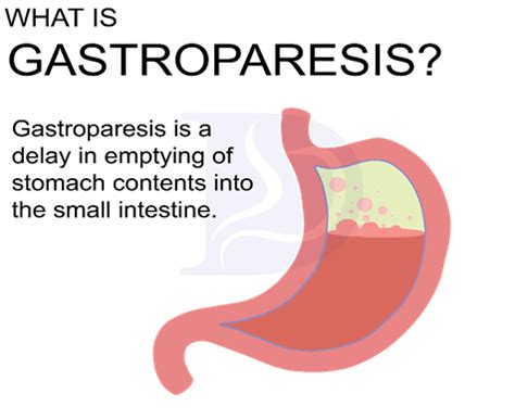 Gastroparesis - Digestive and Liver Health Specialists