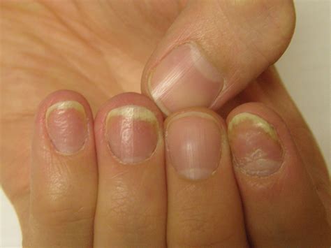 Nail Psoriasis Tips | MDedge Dermatology