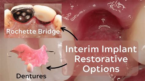 Rochette Bridges and Provisional Prostheses for Implants – PDP145 - YouTube