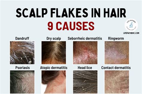 Scalp Flakes in Hair: Dandruff and 8 Other Causes