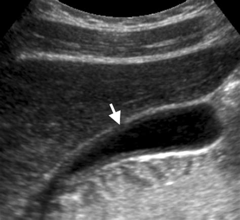 Diffuse Gallbladder Wall Thickening: Differential Diagnosis | AJR