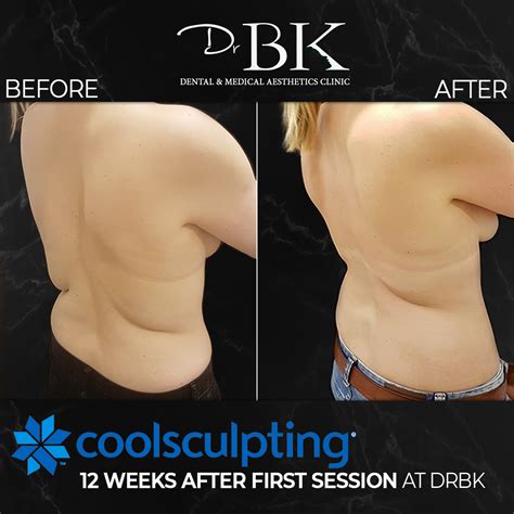 Coolsculpting® Fat Freezing Treatment - DrBK Clinic in Reading